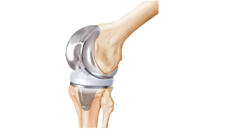 Knee replacement model