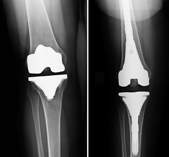 Could Your Knee Replacement Fail?